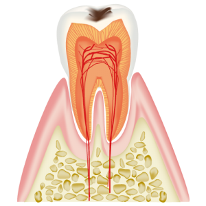 C1　エナメル質内のむし歯